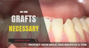 Gum Grafts: Understanding Their Necessity for Oral Health and Smile Aesthetics