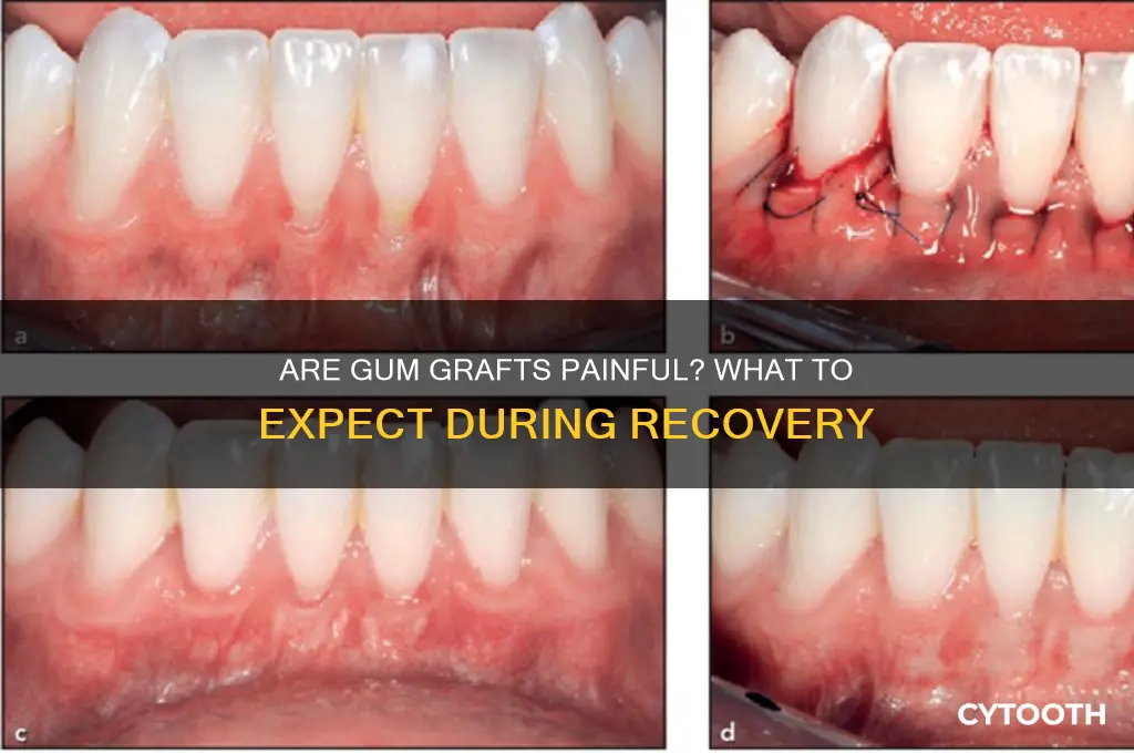 are gum grafts painful