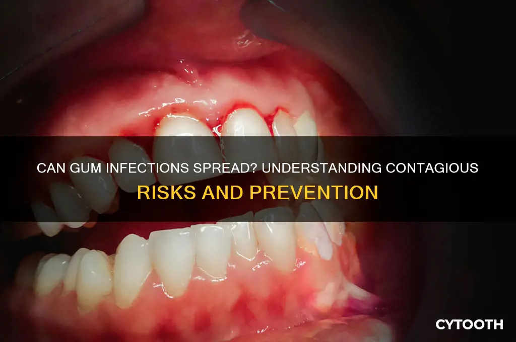 are gum infections contagious