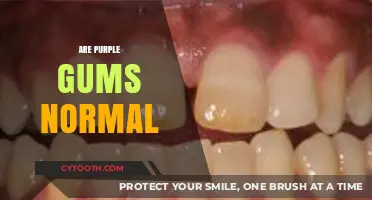 Are Purple Gums Normal? Understanding Gum Color and Oral Health