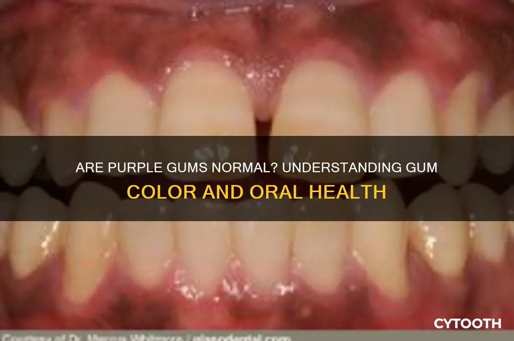 are purple gums normal