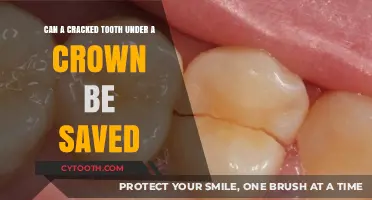 Saving a Cracked Tooth Under a Crown: Is It Possible?