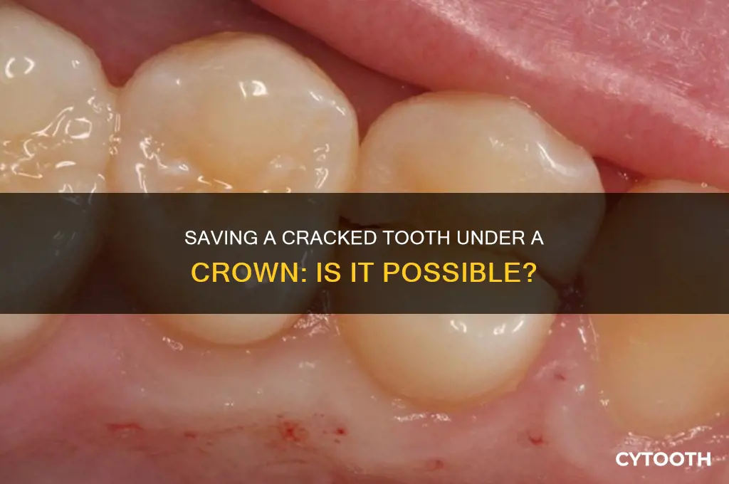 can a cracked tooth under a crown be saved