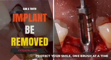 Can a Tooth Implant Be Removed? Understanding the Process and Possibilities