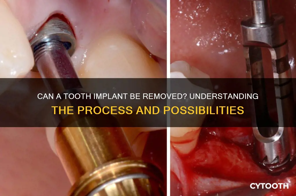 can a tooth implant be removed