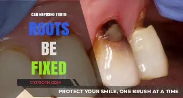 Fixing Exposed Tooth Roots: Treatment Options and Solutions Explained
