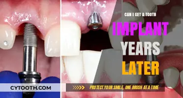 Can You Get a Dental Implant Years After Tooth Loss?