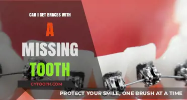 Missing Tooth? Here’s How Braces Can Still Work for You