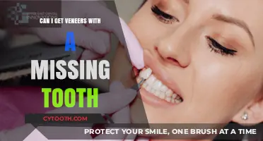 Veneers with a Missing Tooth: What Are Your Options?