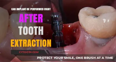 Immediate Dental Implants After Extraction: Benefits, Risks, and Recovery