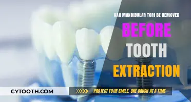 Mandibular Tori Removal: Pre-Extraction Considerations and Surgical Options