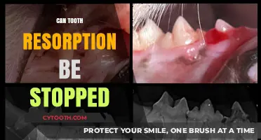 Can Tooth Resorption Be Halted? Understanding Causes and Treatment Options