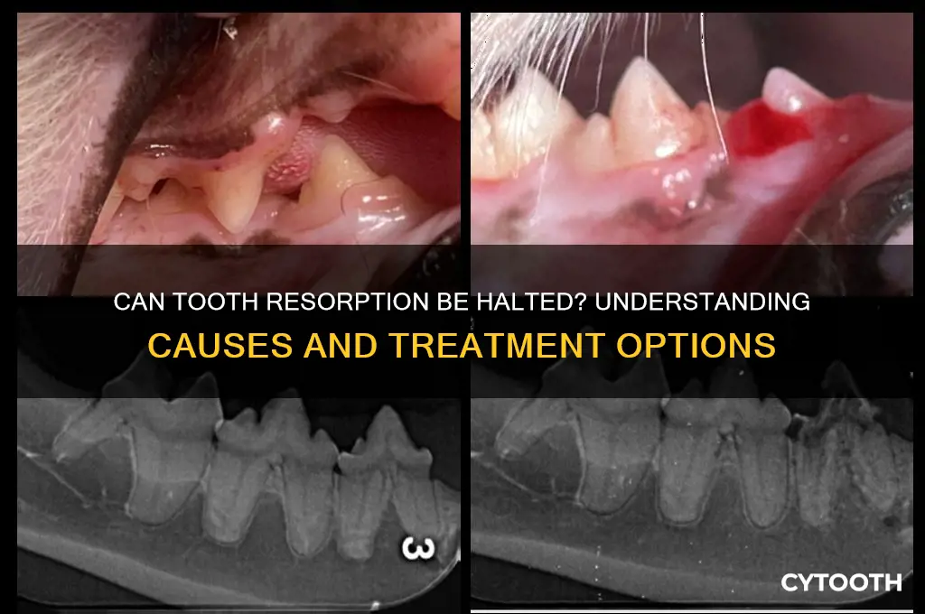 can tooth resorption be stopped