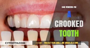 Can Veneers Fix Crooked Teeth? A Comprehensive Guide to Smile Makeovers
