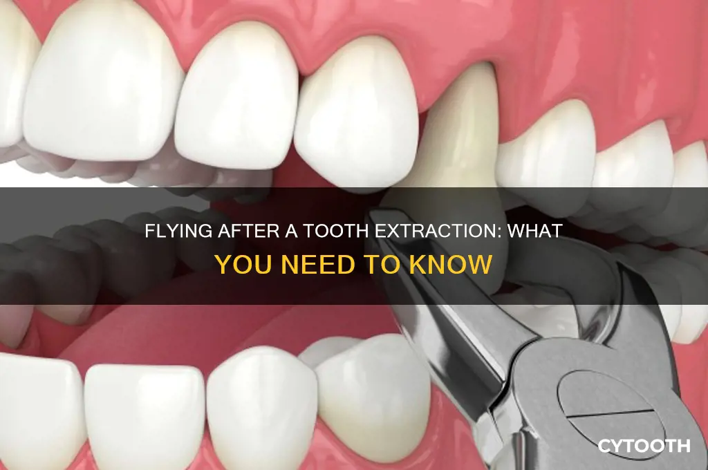 can you fly after having a tooth removed