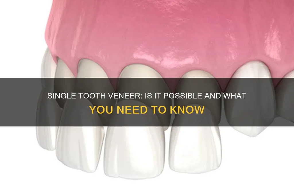 can you get a veneer on one tooth