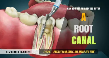 Can Abscesses Occur Post-Root Canal Treatment? Understanding the Risks