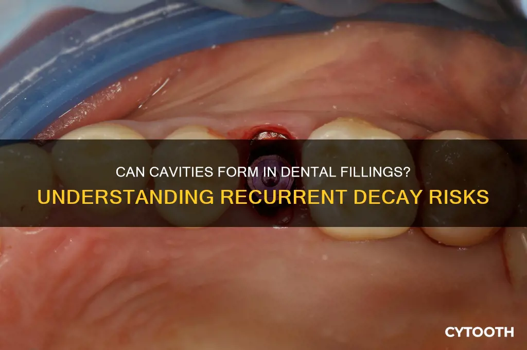 can you get cavities in fillings