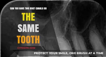 Can You Have Two Root Canals on the Same Tooth?