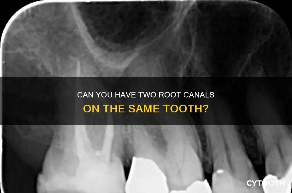 can you have two root canals on the same tooth