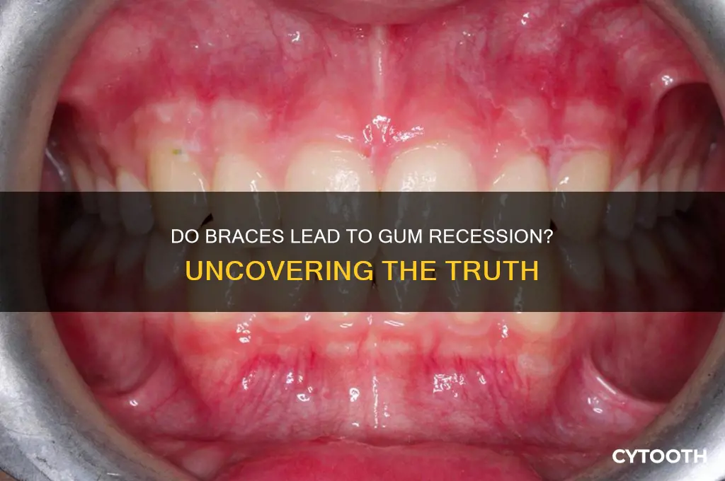 do braces cause gum recession