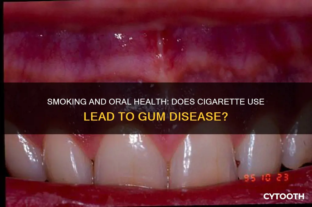 do cigarettes cause gum disease