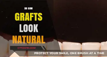 Do Gum Grafts Look Natural? A Comprehensive Guide to Results