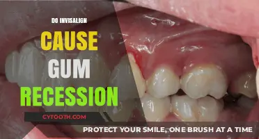 Invisalign and Gum Recession: What You Need to Know