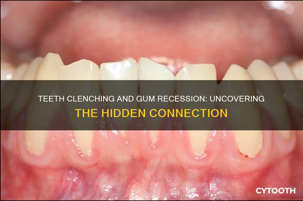 does clenching teeth cause gum recession