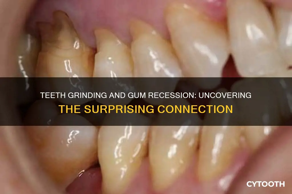 does grinding teeth cause receding gums