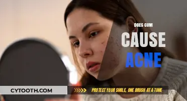 Does Gum Cause Acne? Unraveling the Myth and Facts