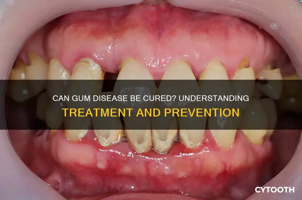 does gum disease go away