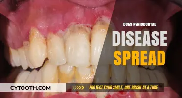 Can Periodontal Disease Spread? Understanding Risks and Prevention Methods