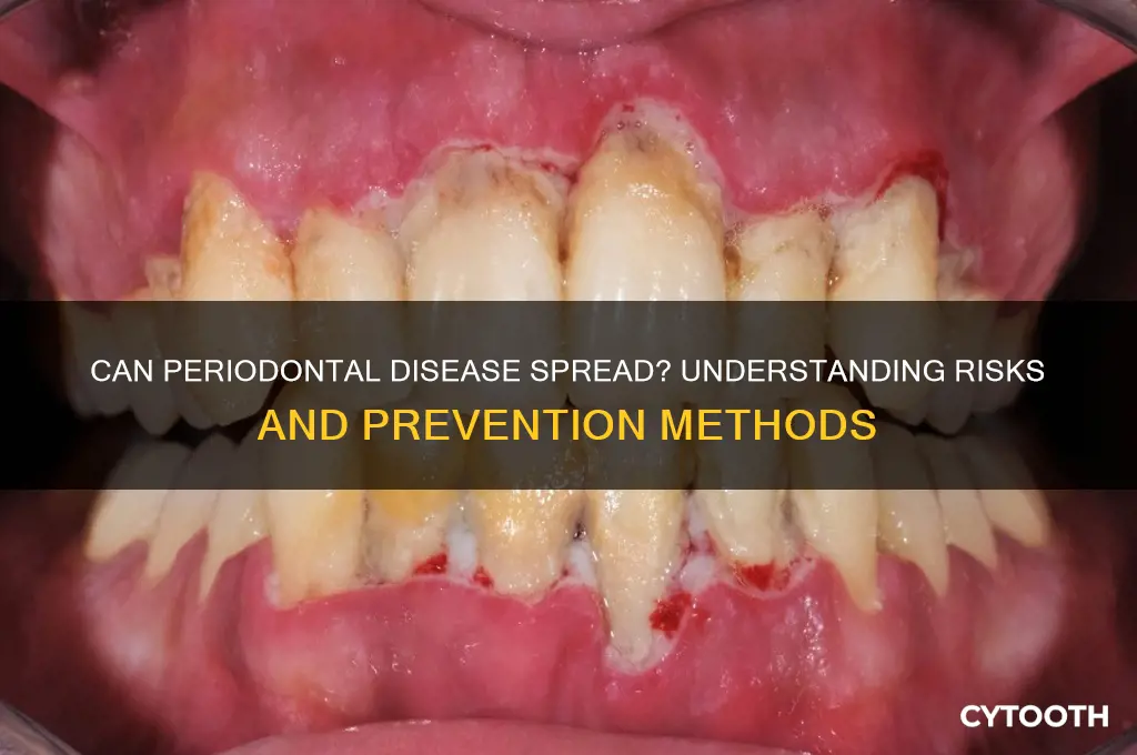 does periodontal disease spread