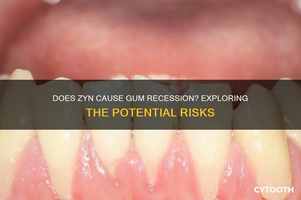 does zyn make your gums recede