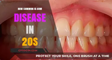 Gum Disease in Your 20s: Prevalence, Risks, and Prevention Tips