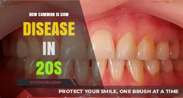Gum Disease in Your 20s: Prevalence, Risks, and Prevention Tips