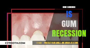 Understanding Gum Recession: How Common Is It and Why It Happens