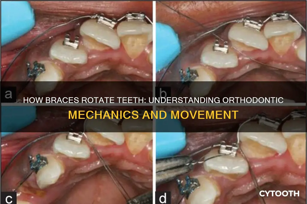 how do braces rotate a tooth
