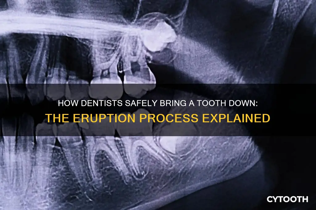 how do dentists bring a tooth down