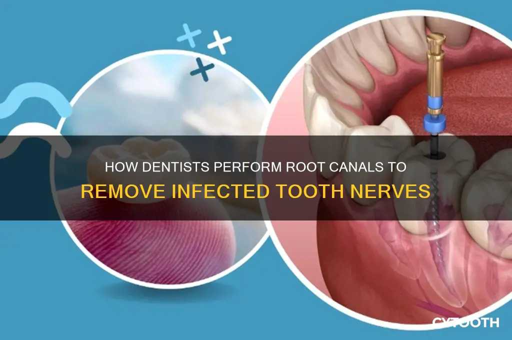 how do dentists kill a tooth nerve