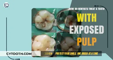 Treating Exposed Pulp: Dentists' Techniques to Save Your Tooth