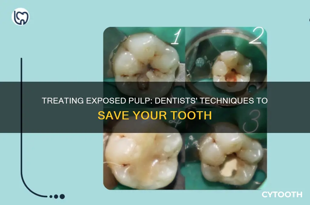 how do dentists treat a tooth with exposed pulp