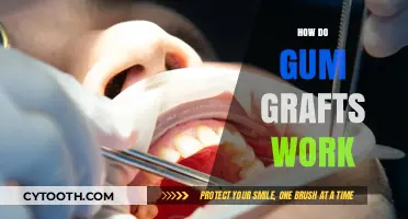 Understanding Gum Grafts: Procedure, Recovery, and Benefits Explained