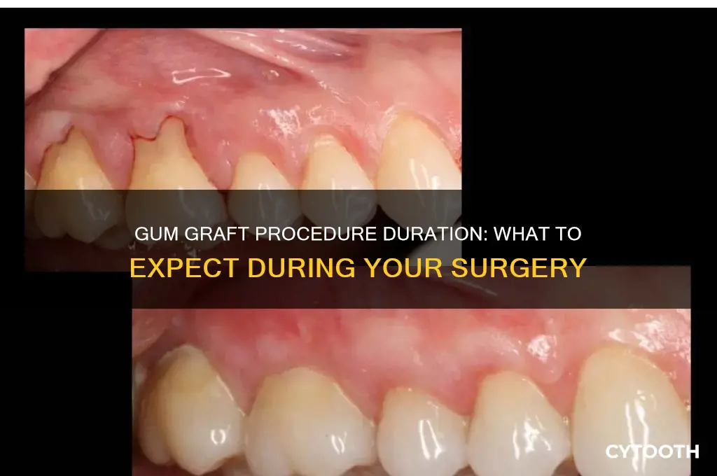 how long does a gum graft procedure take