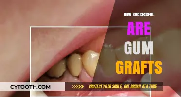 Gum Graft Success: What to Expect and How Effective It Is
