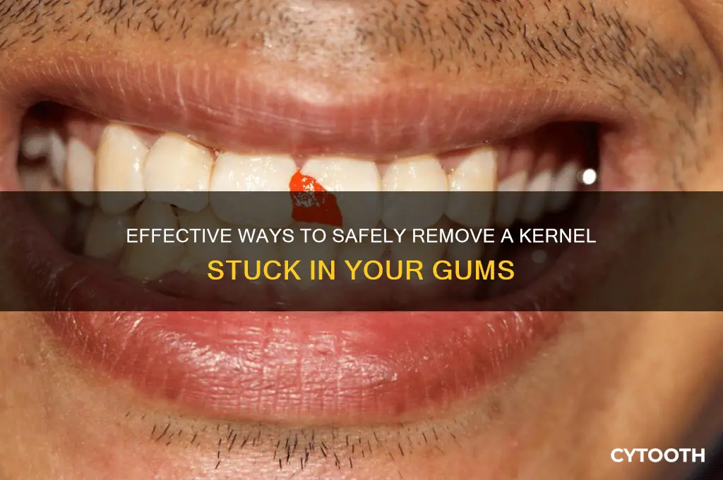 how to get a kernel out of your gums