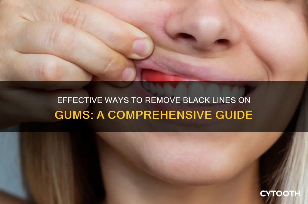 how to get rid of black line on gums
