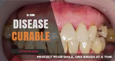 Can Gum Disease Be Cured? Understanding Treatment and Prevention Options