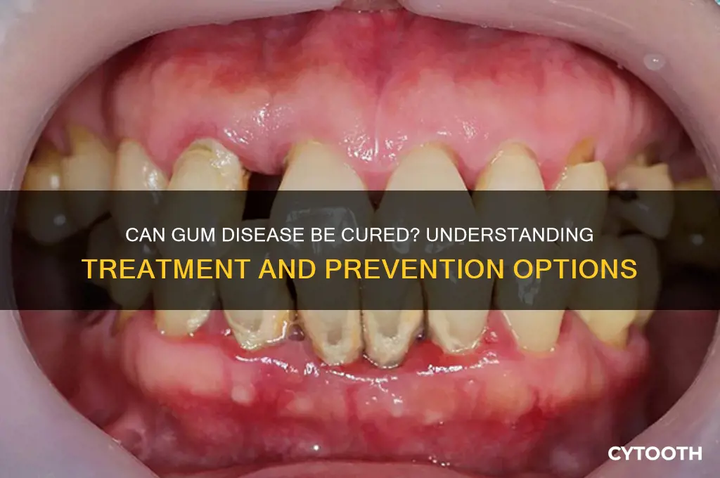 is gum disease curable